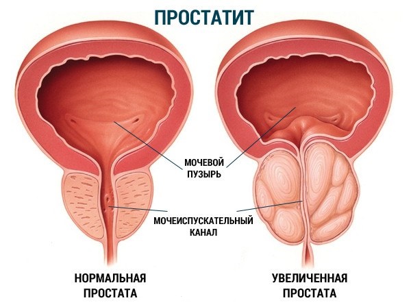 Секрет простаты